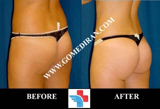 Brazilian butt lift surgery before and after in Iran