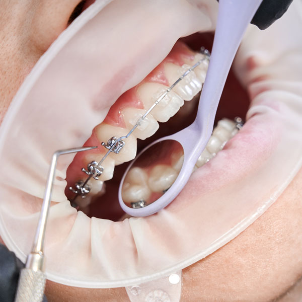  The Benefits of Traditional Braces