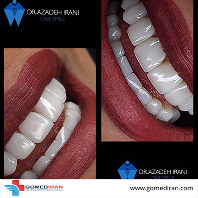 Dr. Azadeh Irani Before and afters