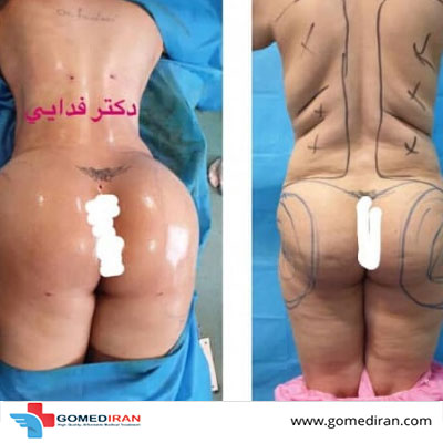 Dr. Mohsen Fadaei Before and afters