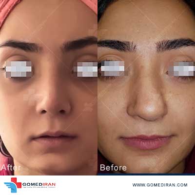 rhinoplasty before and after in iran