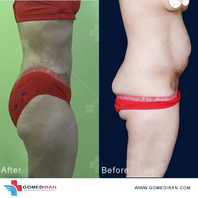tummy tuck before and after in iran