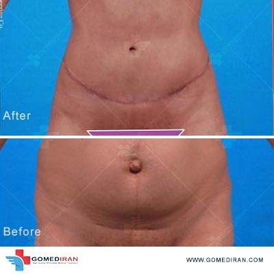 tummy tuck before and after in iran