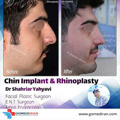 Dr. Yahyavi Before and afters