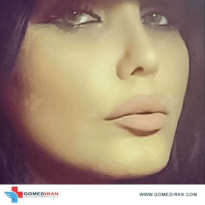 rhinoplasty before and after Dr yahyavi