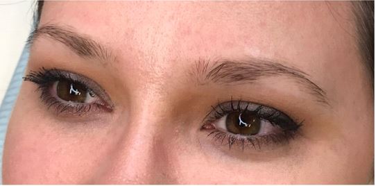 Eyebrow transplant in Iran before and after