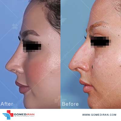 Dr. Ali Gharooni Before and afters