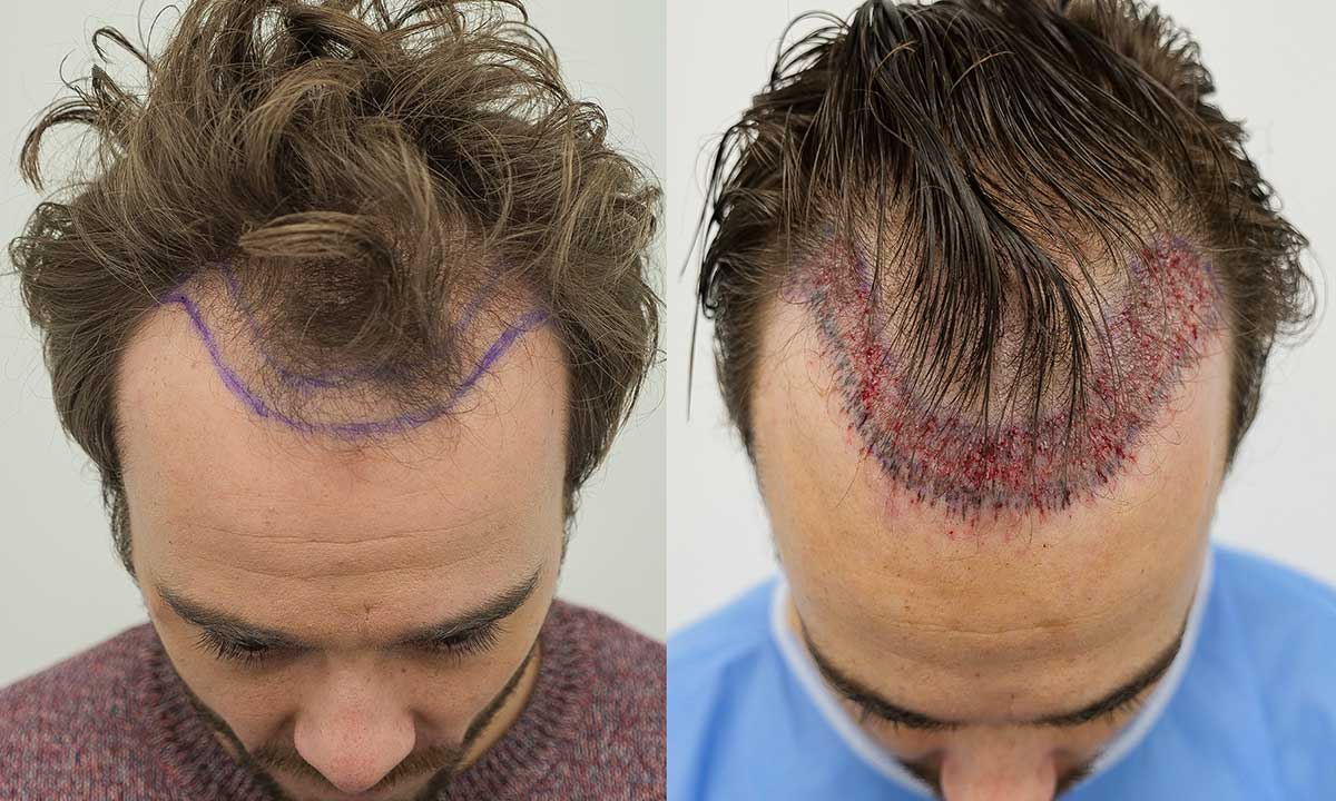 hair transplant in Iran before and after.