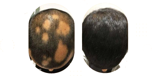 hair transplant for alopecia areata