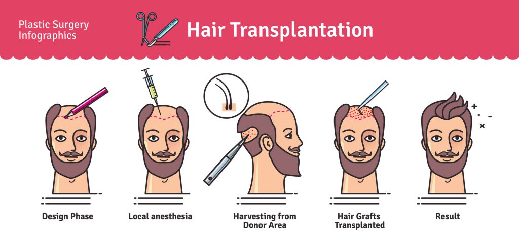 Hair Loss Reasons Signs Hair Transplant Gomediran