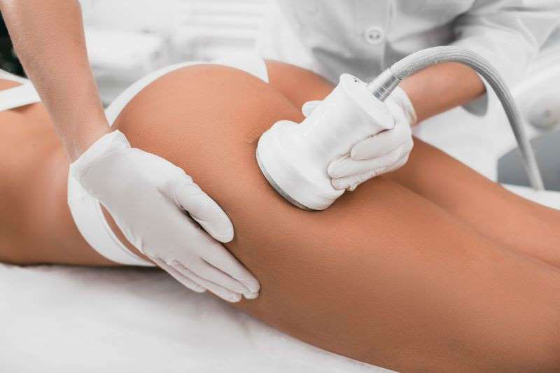 Radiofrequency lipolysis fat removal