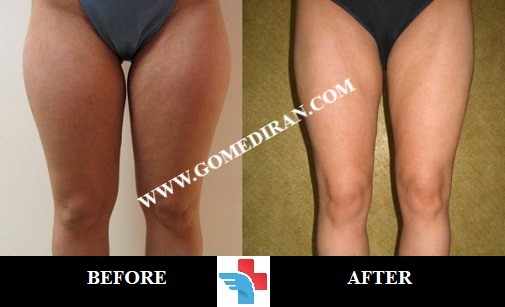 Thigh lift surgery before and after in Iran