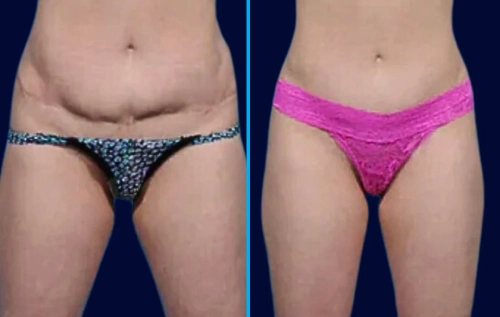 tummy tuck revision