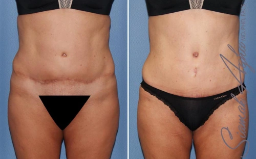 tummy tuck revision